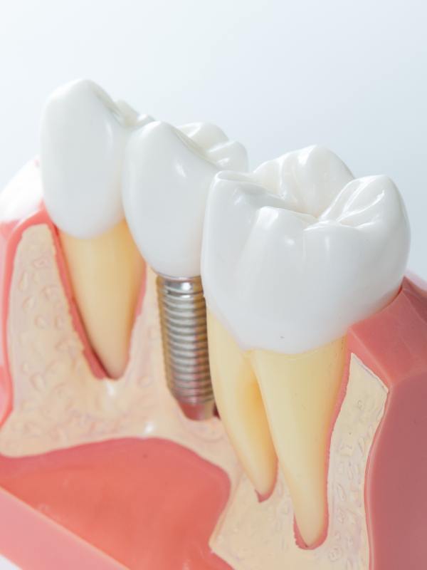 Implantology Consultation with CBCT 3D Diagnostic Evaluation